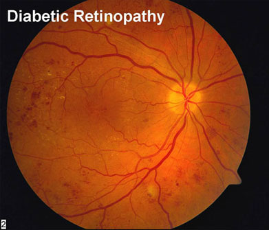 Retinal Specialist in Los Angeles