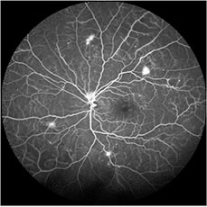 Retinal Specialist in Los Angeles